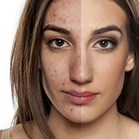 Acne needs to be taken more seriously, say charities
